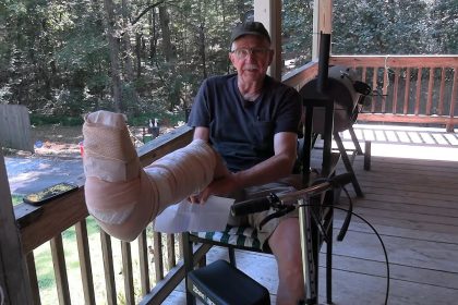 I Broke my Leg!